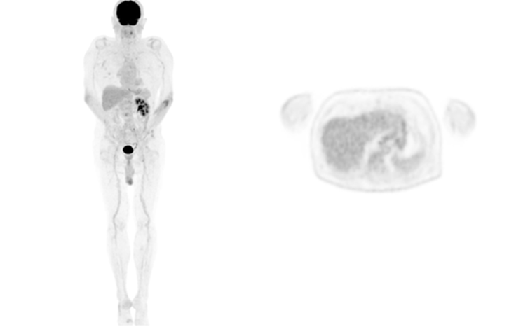 MIP and axial image of the same patient scanned on uMI 550