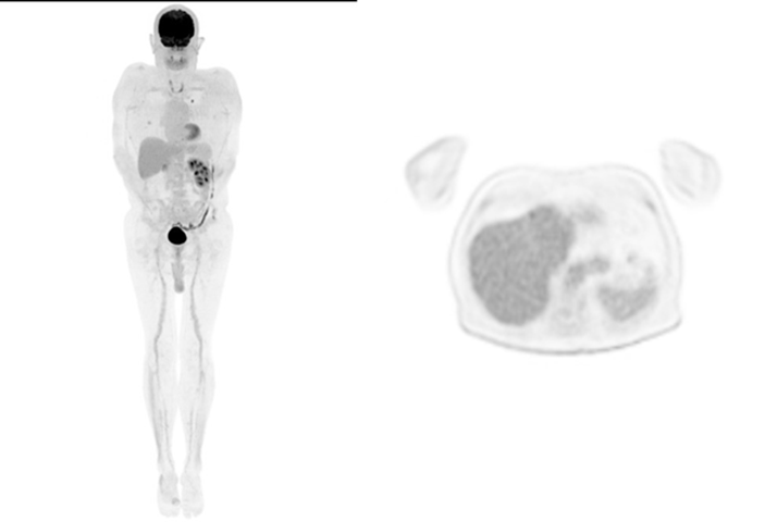 MIP and axial image of patient with metastatic renal cell carcinoma scanned on uMI 780