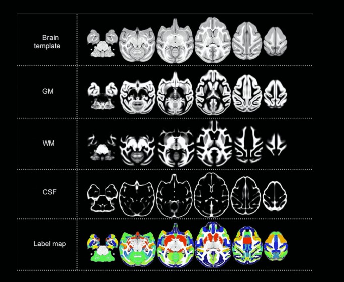 Individual Brain Differences Based on a Population MRI-Based Atlas