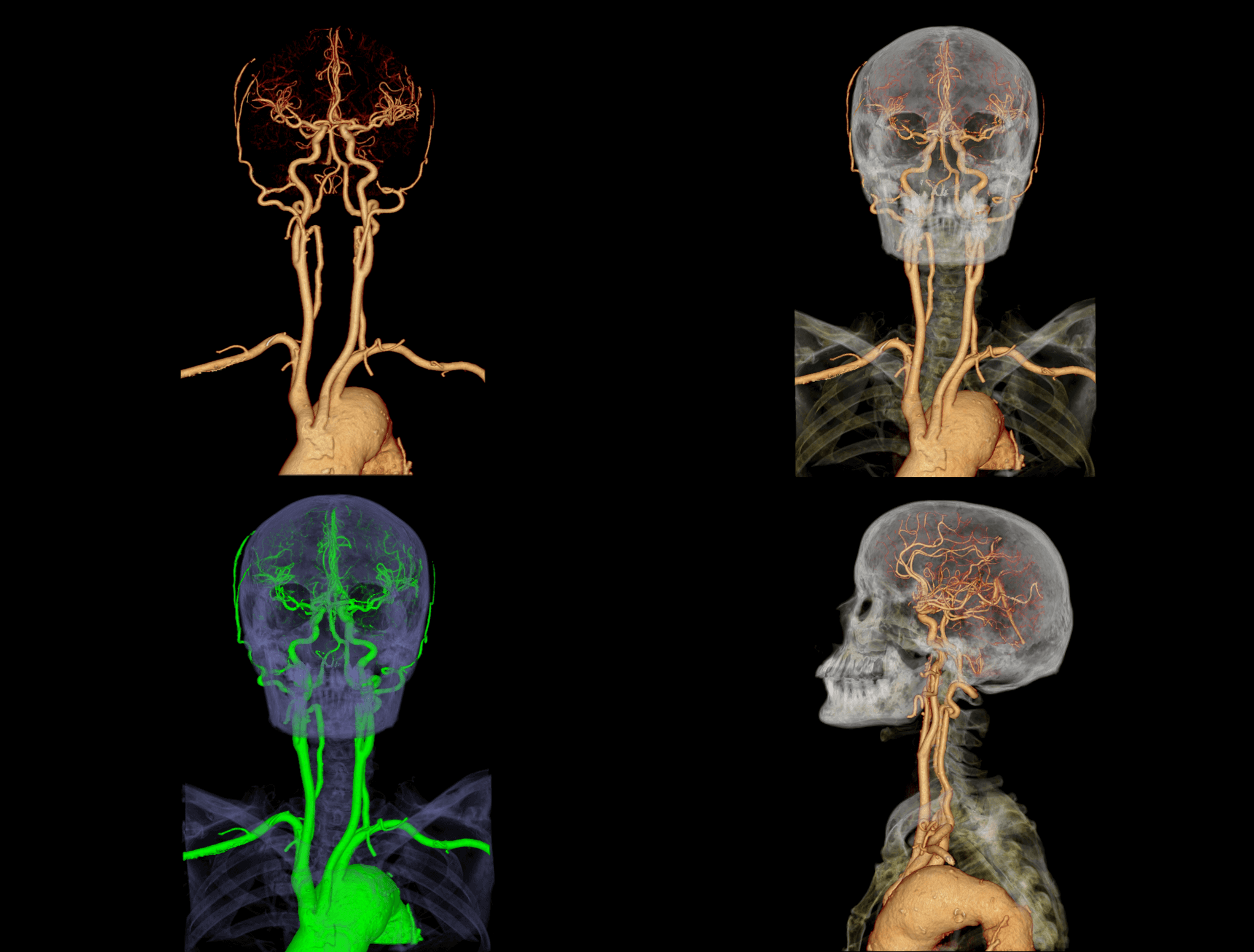 Head and Neck CTA