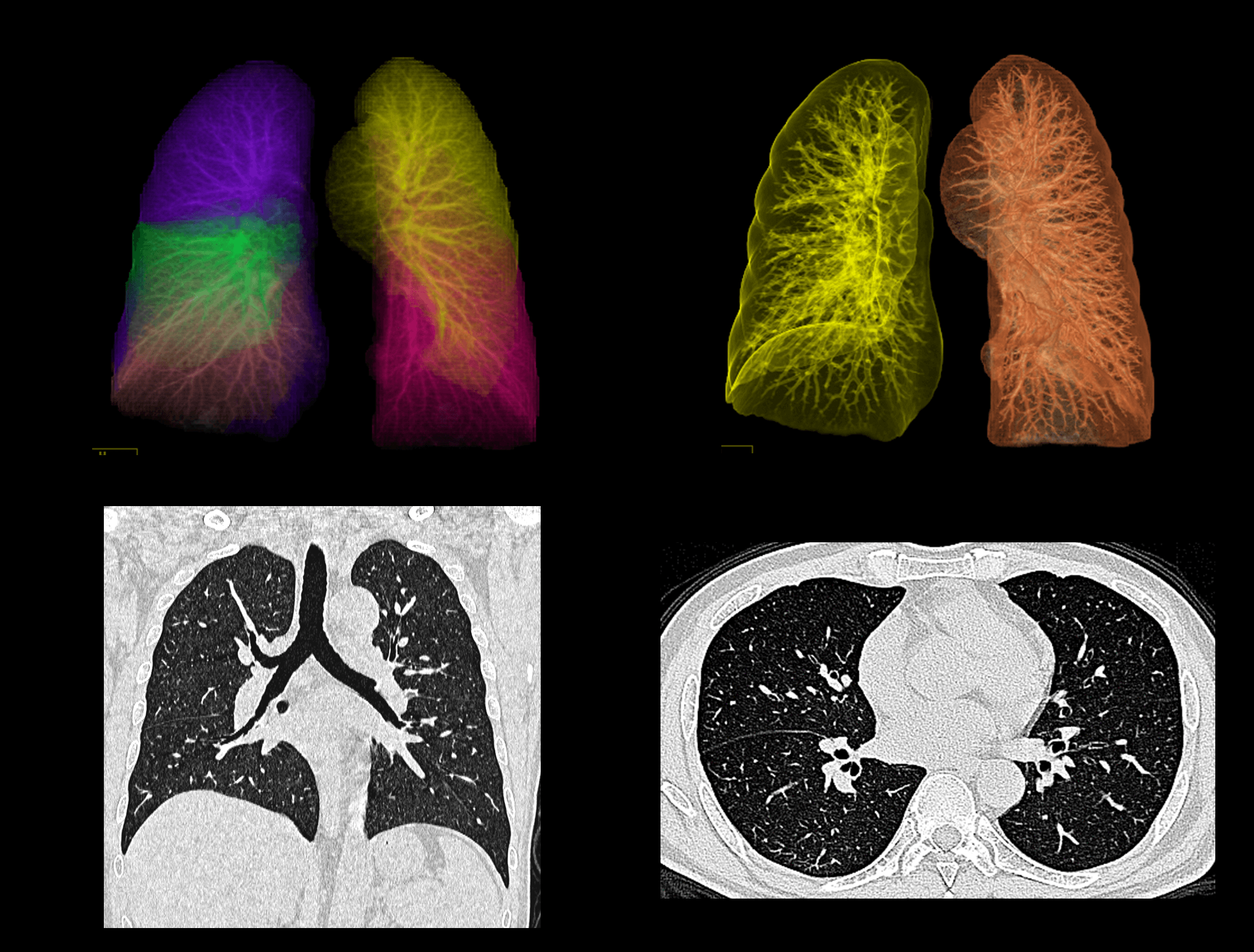 Lung Density Analysis