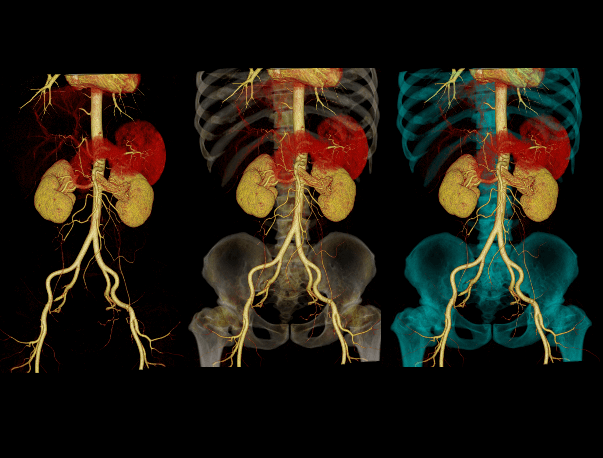 Large Range Scan-Abdominal CTA 