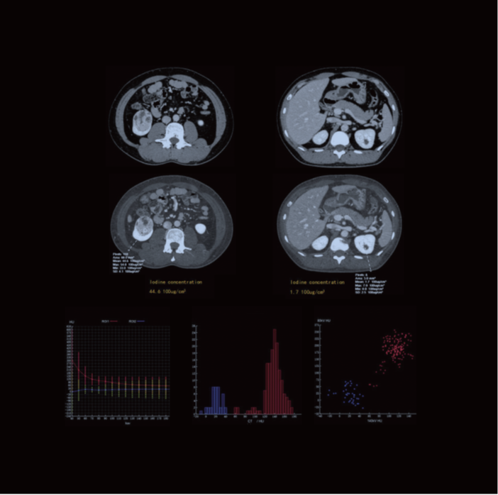 The spectral curves demonstrate the different tissues of the bilateral renal lesions.