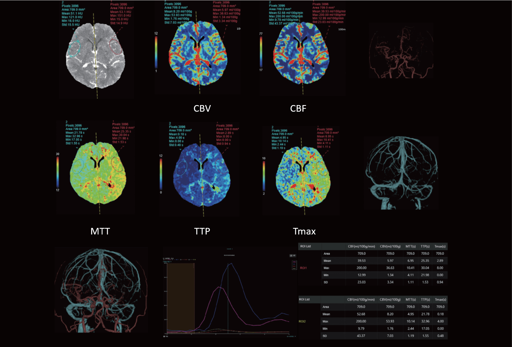 CBV,CBF,MTT, TTP, and Tmax perfusion data to create a ROI time density curve and one- click generation of parameters.