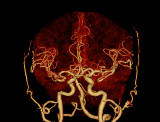 arterial phase CTA image