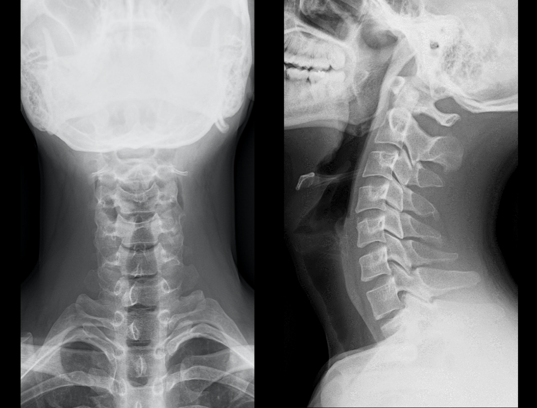 Cervical Vertebrae AP & LAT
