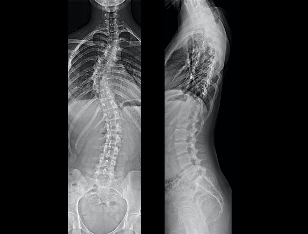 Whole Spine AP & LAT