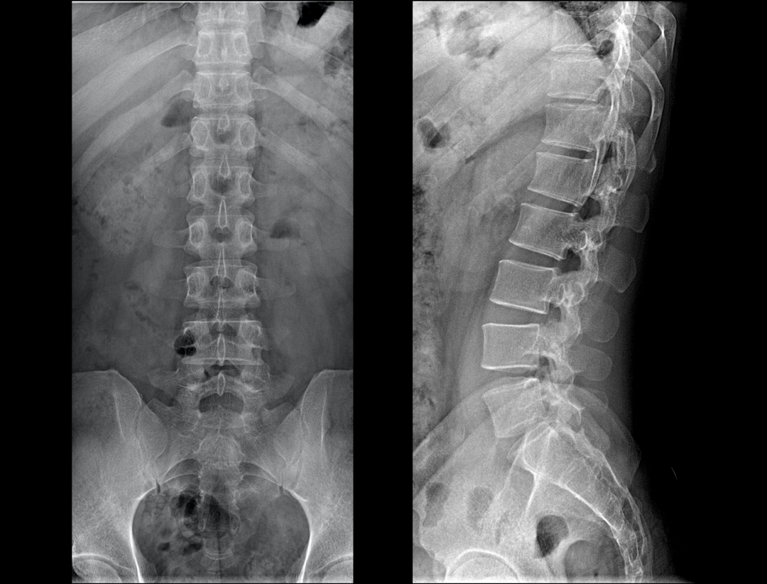 Lumber Vertebrae AP & LAT