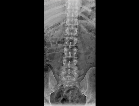 lumbar spine AP projection​
