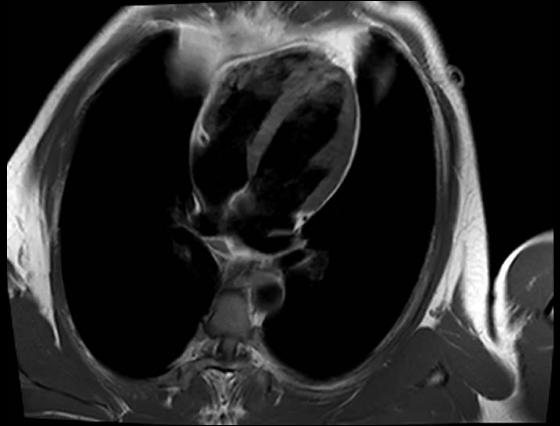 T1W FSE DB 4CH imaging