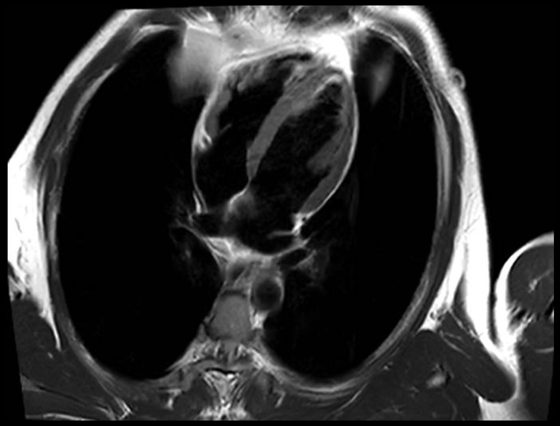 T2W FSE DB 4CH imaging