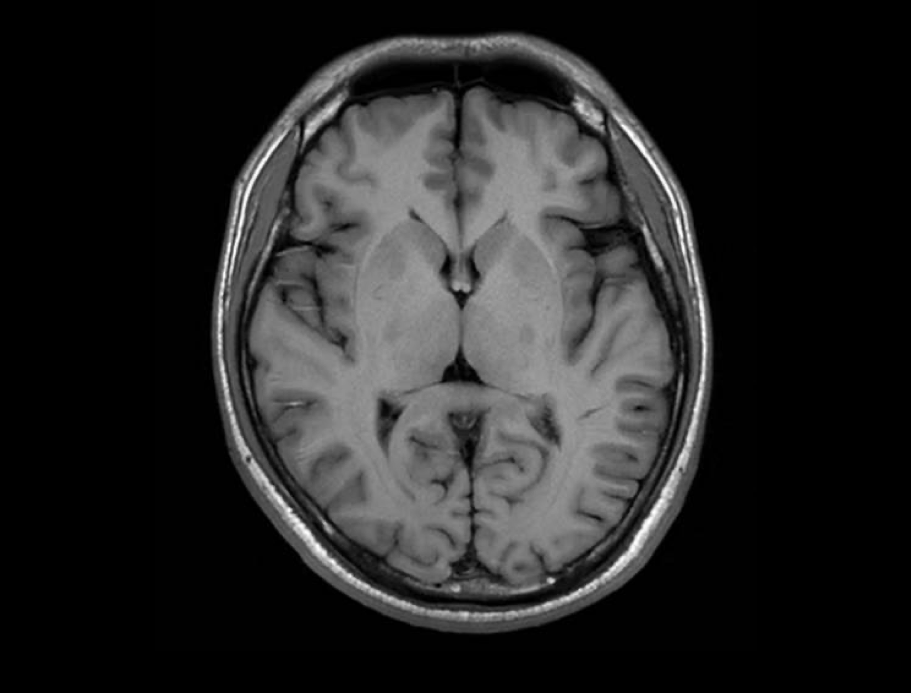 T1 FSE FLAIR imaging