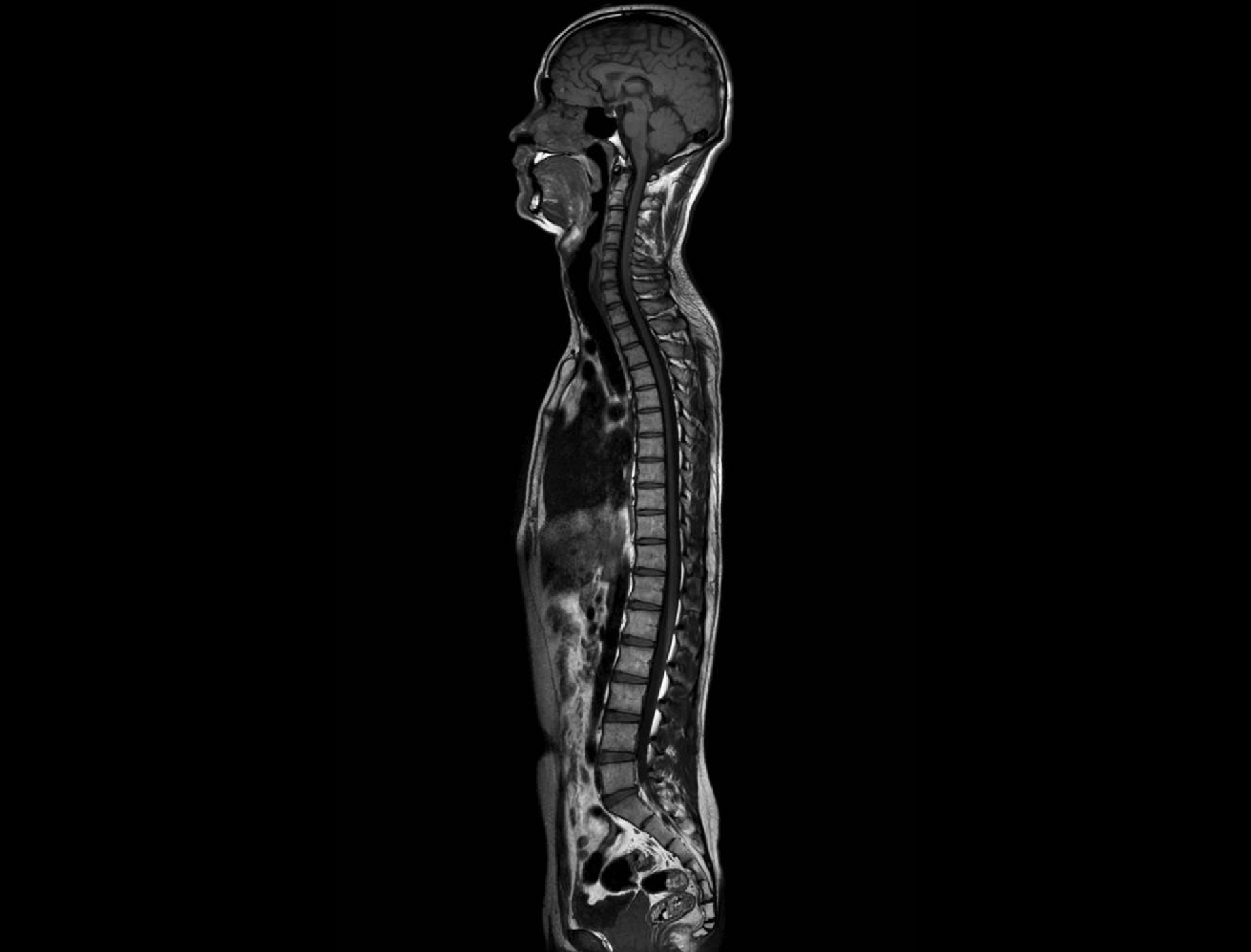Whole-spine T1WI Stitching imaging