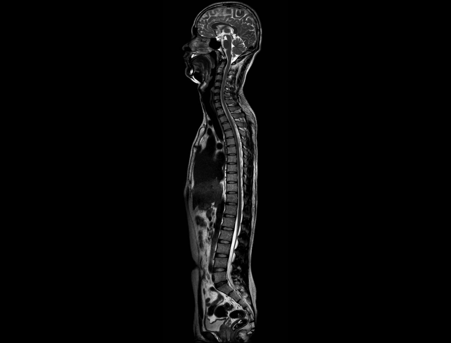 Whole-spine T2WI Stitching imaging