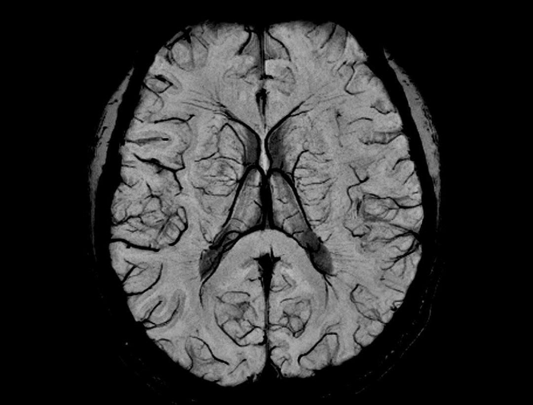 head susceptibility weighted imaging