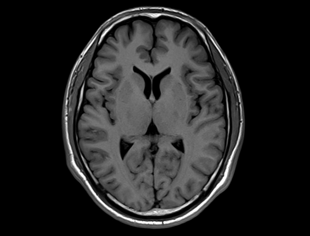 T1-weighted image of head