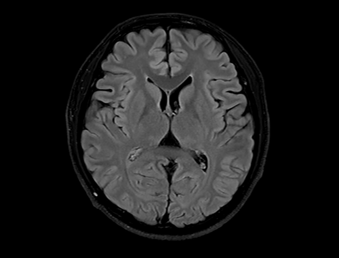  T1-weighted image Fluid-attenuated inversion recovery Fat-saturation
