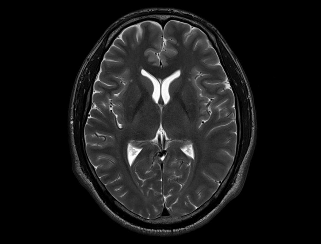 T2 weighted image of head