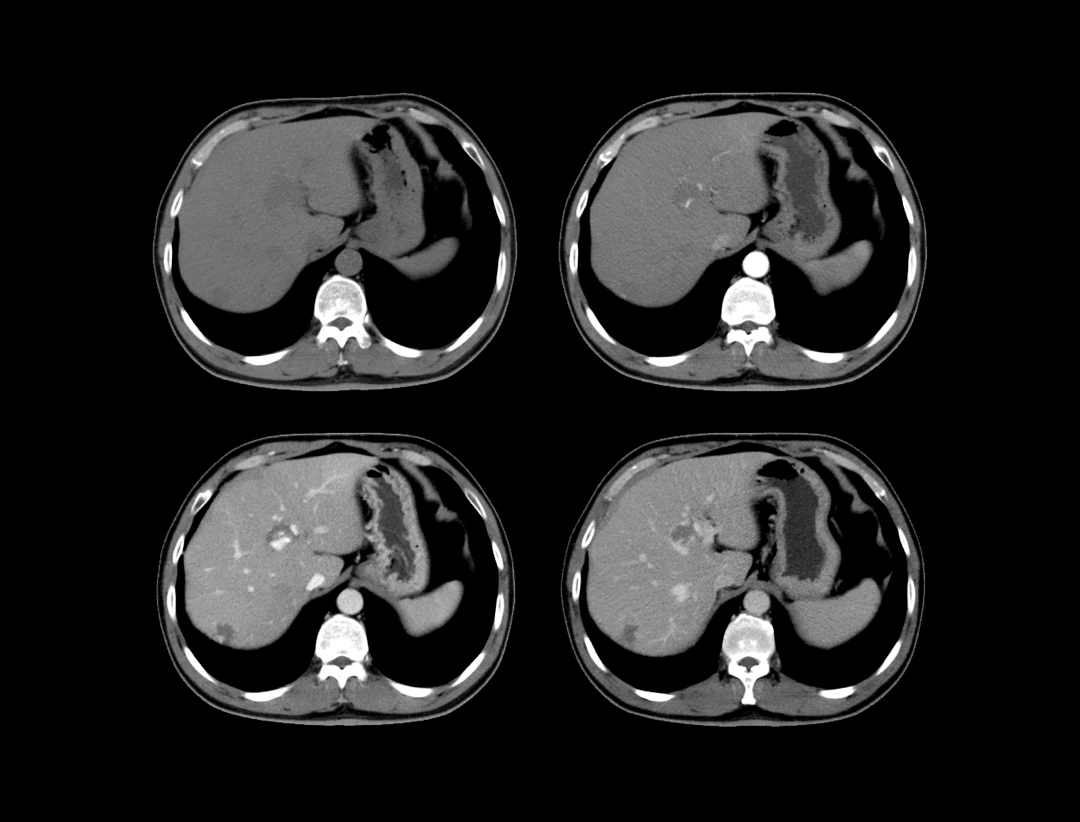 Contrast Enhanced Abdomen Scan