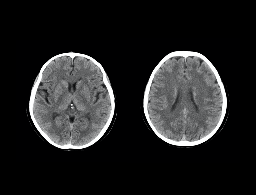 Non-contrast Head Scan