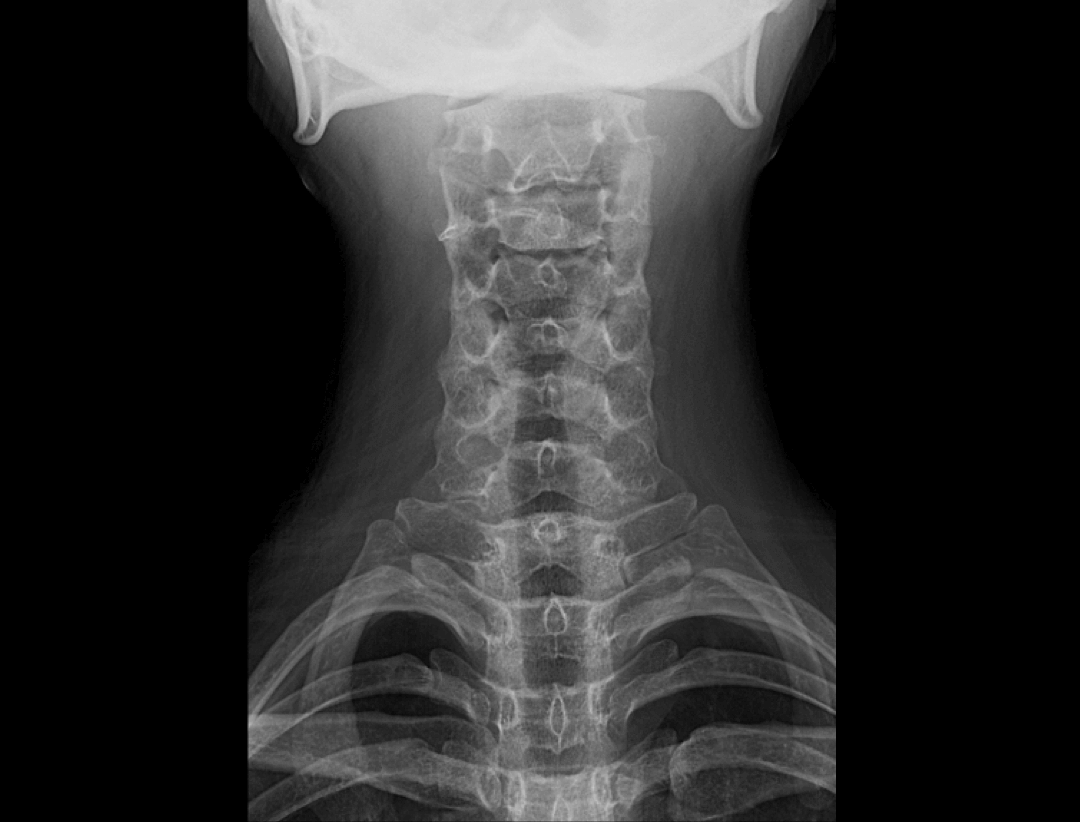 Cervical Vertebrae AP