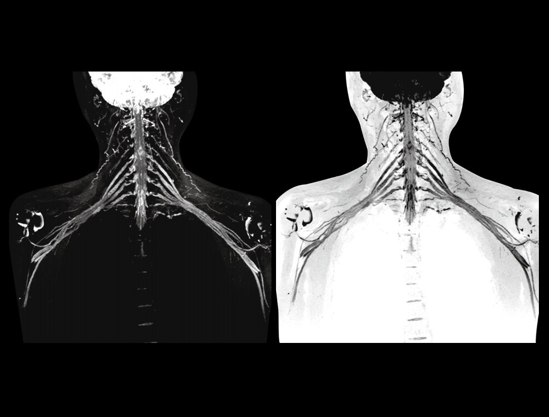 imaging of brachial plexus
