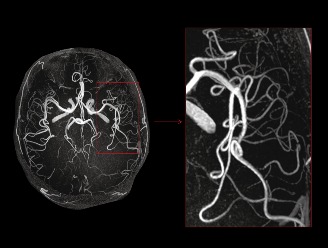 Time-of-Flight (TOF) MR Angiography of the brain
