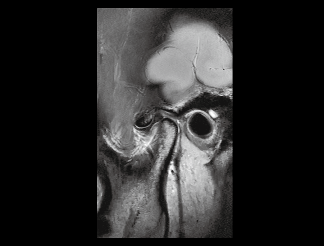 TMJ imaging