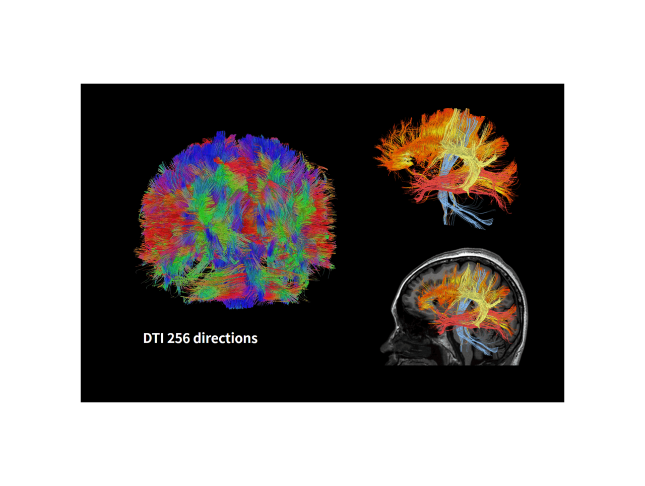 256 directions  Diffusion tensor imaging of brain