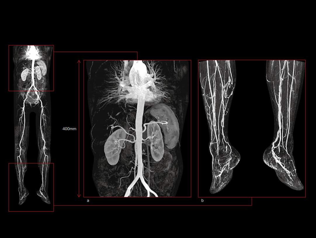 Body and lower extremity arteries CE-MRA