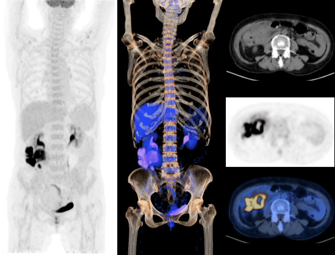 uMI Vista: Digital PET/CT | United-Imaging Healthcare