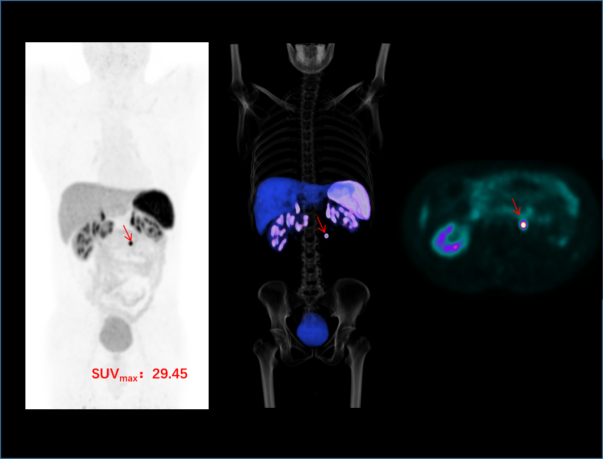 uMI 780: HD Digital PET/CT | United-Imaging Healthcare