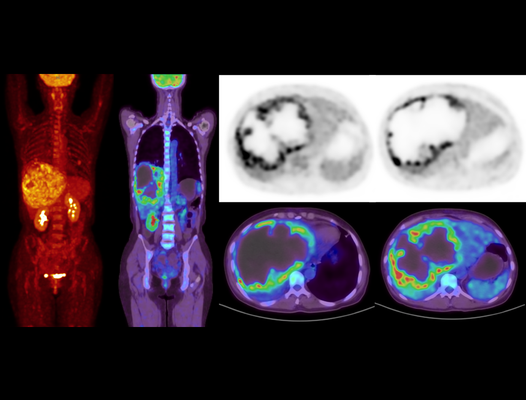 uMI Vista: Digital PET/CT | United-Imaging Healthcare